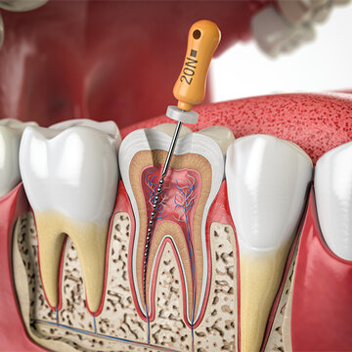 Root canal treatment in RS Puram Coimbatore
