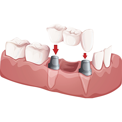 Crowns for teeth in RS Puram Coimbatore