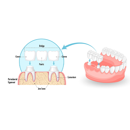 Crowns for teeth in RS Puram Coimbatore