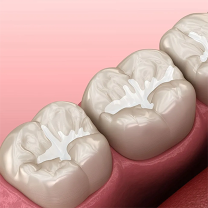 Teeth Filling in RS Puram Coimbatore