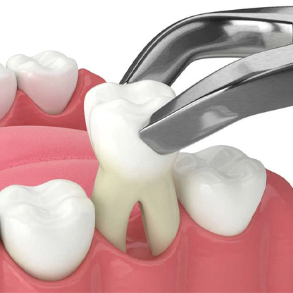 Teeth Removal in RS Puram,Coimbatore