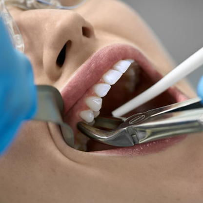 Teeth Removal in RS Puram,Coimbatore